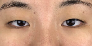 79 [Instant Double Eyelid Surgery]