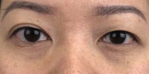 80 [Instant Double Eyelid Surgery]