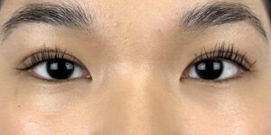 83 [Instant Double Eyelid Surgery]
