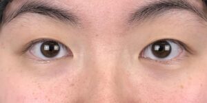 84 [Instant Double Eyelid Surgery]