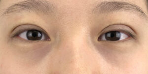 90 [Instant Double Eyelid Surgery]