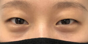 90 [Instant Double Eyelid Surgery]