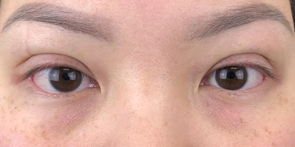 101 [Instant Double Eyelid Surgery]