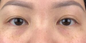 101 [Instant Double Eyelid Surgery]