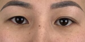 100 [Instant Double Eyelid Surgery]