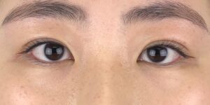 91 [Instant Double Eyelid Surgery]