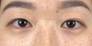 93 [Instant Double Eyelid Surgery]