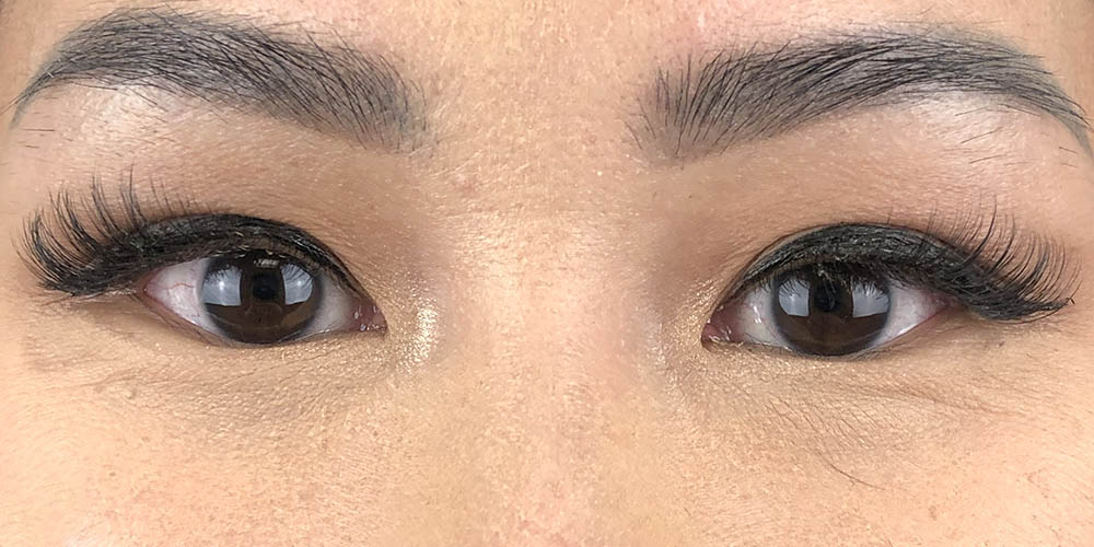 95 [Instant Double Eyelid Surgery]