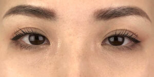 96 [Instant Double Eyelid Surgery]