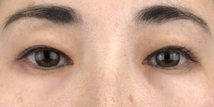98 [Instant Double Eyelid Surgery]