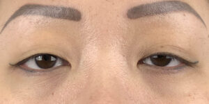 102 [Instant Double Eyelid Surgery]