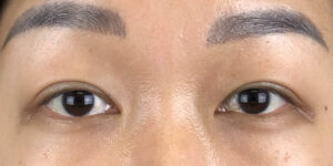 103 [Instant Double Eyelid Surgery]