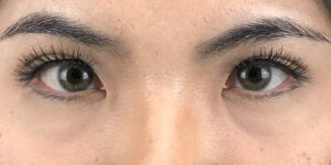 105 [Instant Double Eyelid Surgery]