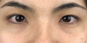 105 [Instant Double Eyelid Surgery]