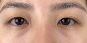 108 [Instant Double Eyelid Surgery]