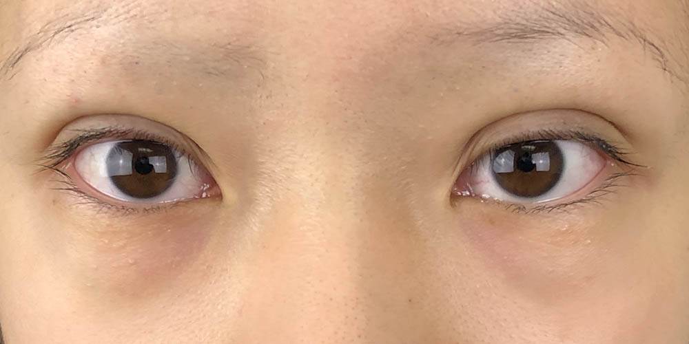 109 [Instant Double Eyelid Surgery]