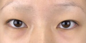 109 [Instant Double Eyelid Surgery]