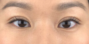 117 [Instant Double Eyelid Surgery]