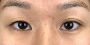 117 [Instant Double Eyelid Surgery]