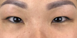 118 [Instant Double Eyelid Surgery]