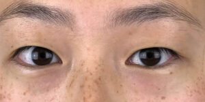 119 [Instant Double Eyelid Surgery]