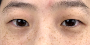 122 [Instant Double Eyelid Surgery]
