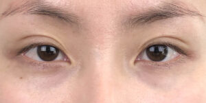 123 [Instant Double Eyelid Surgery]