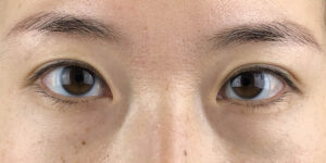 124 [Instant Double Eyelid Surgery]