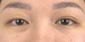 125 [Instant Double Eyelid Surgery]