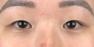 127 [Instant Double Eyelid Surgery]