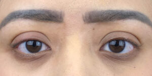 129 [Instant Double Eyelid Surgery]
