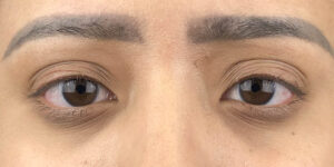 129 [Instant Double Eyelid Surgery]