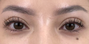 130 [Instant Double Eyelid Surgery]