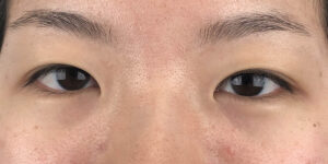 133 [Instant Double Eyelid Surgery]