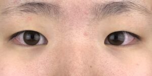 135 [Instant Double Eyelid Surgery]