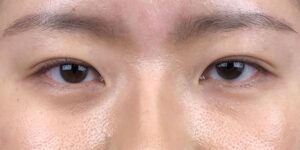139 [Instant Double Eyelid Surgery]