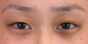 146 [Instant Double Eyelid Surgery]