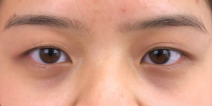 141 [Instant Double Eyelid Surgery]