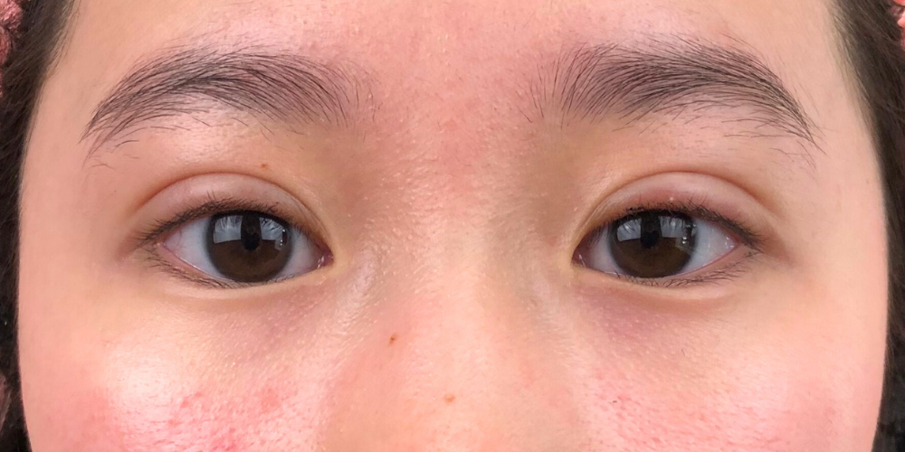 Instant Double Eyelid Cosmetic Surgery | Shonan Beauty Clinic