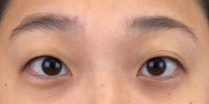 159 [Instant Double Eyelid Surgery]