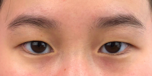 160 [Instant Double Eyelid Surgery]