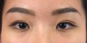 168 [Instant Double Eyelid Surgery]