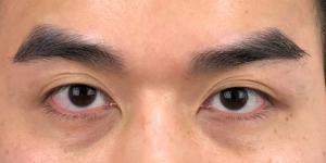 170 [Instant Double Eyelid Surgery]