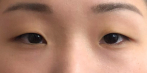 178 [Instant Double Eyelid Surgery]