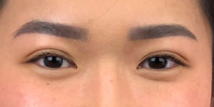 185 [Instant Double Eyelid Surgery]