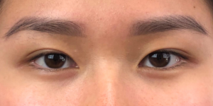 186 [Instant Double Eyelid Surgery]