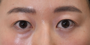 181 [Instant Double Eyelid Surgery]