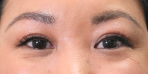 182 [Instant Double Eyelid Surgery]