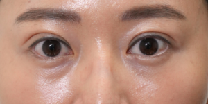 181 [Instant Double Eyelid Surgery]