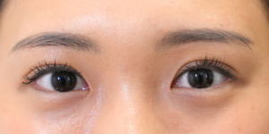 191 [Instant Double Eyelid Surgery]